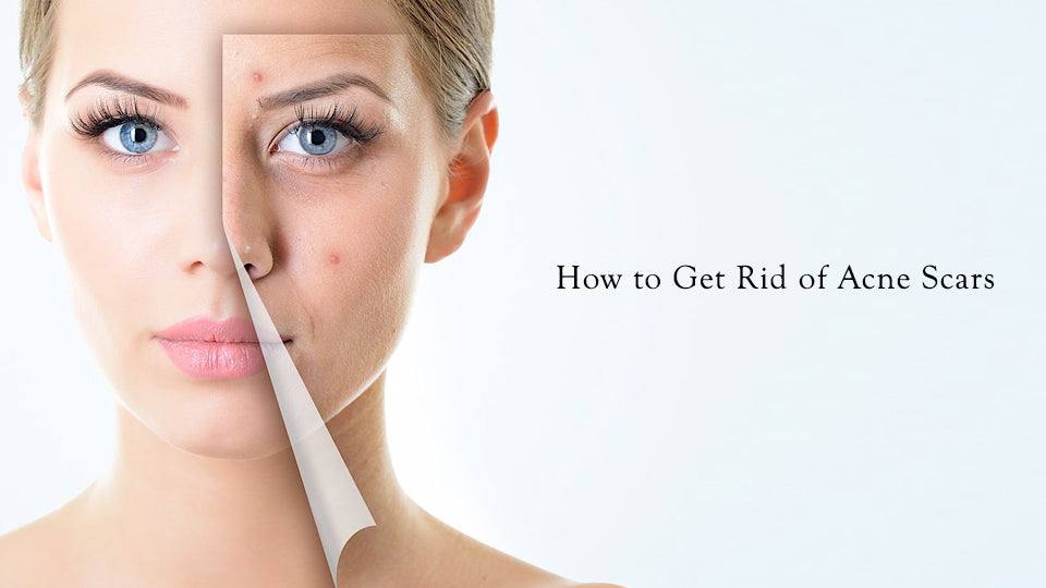 How to get rid of acne scars?