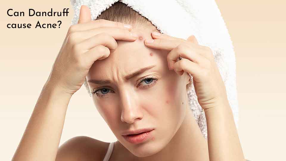 Can Dandruff cause Acne?