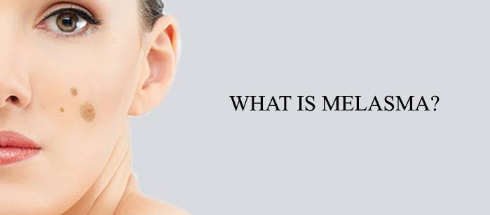 What is Melasma